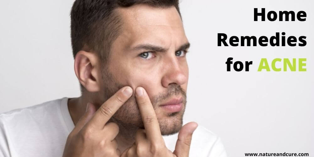 Home Remedies for Acne