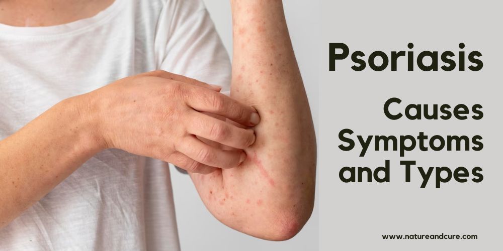 Psoriasis