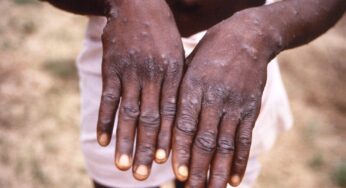 Mpox Vaccines Rolling Out in High-Priority Provinces? How to Naturally Reduce its Impact?
